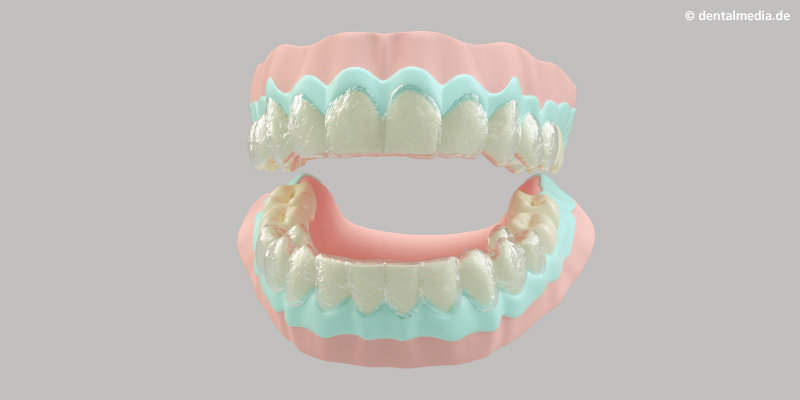Das Bleaching-Gel wird auf die Zähne aufgetragen.