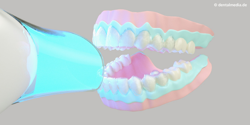 Mit der UV-Lampe wird das Bleaching-Gel aktiviert.